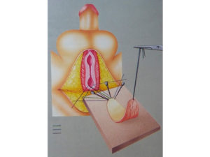 Uretroplastia con colgajo de mucosa bucal