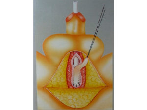 Uretroplastia con colgajo de mucosa bucal